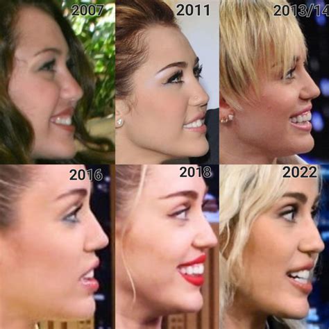 Miley Cyrus Plastic Surgery: A Comprehensive Look