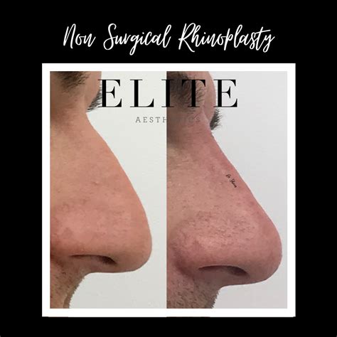 Non Surgical Nose Job vs Surgical Rhinoplasty