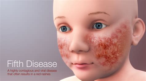 Fifths Disease Rash Pictures at Jared Harper blog