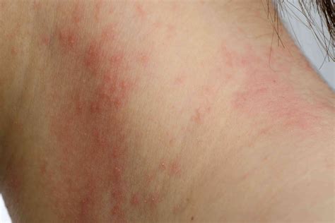 Why Do I Have a Rash on My Neck?