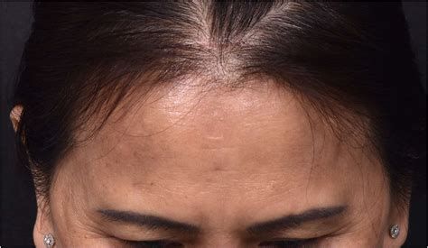 Lipomas & Osteomas Case 16373