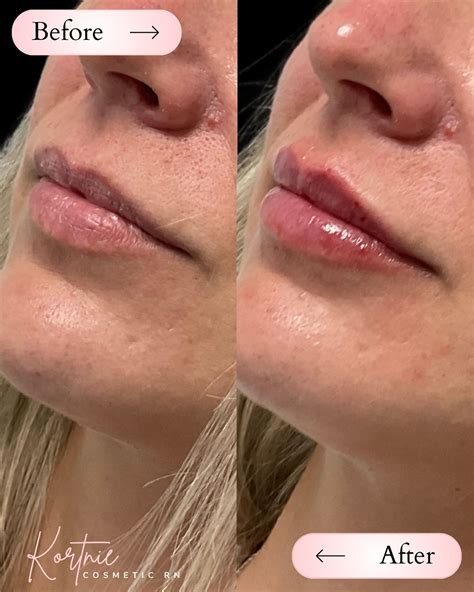 The Lip Lounge Aesthetic Clinic (@theliploungeclinic) • Instagram ...