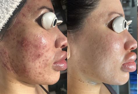 Acne Scars Before And After Chemical Peel