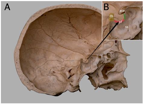 Sphenoid Bone Sella Turcica