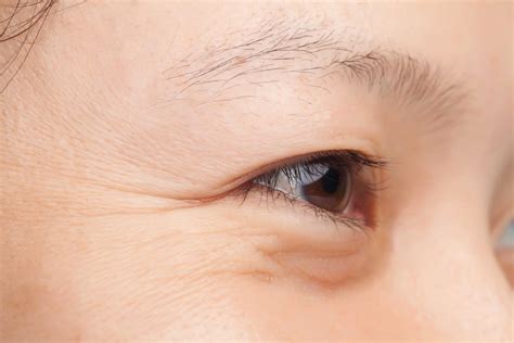 Under-Eye Bags: Causes & Non-Surgical Treatment Options