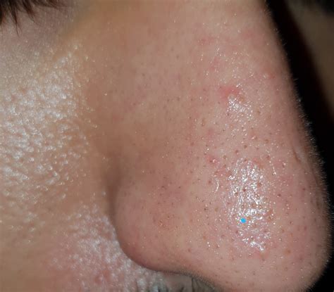 What Are Nose Bumps at Gail Carroll blog