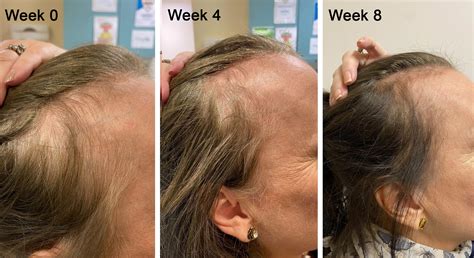 PRP Hair Loss Treatment - Diamond Skin Care