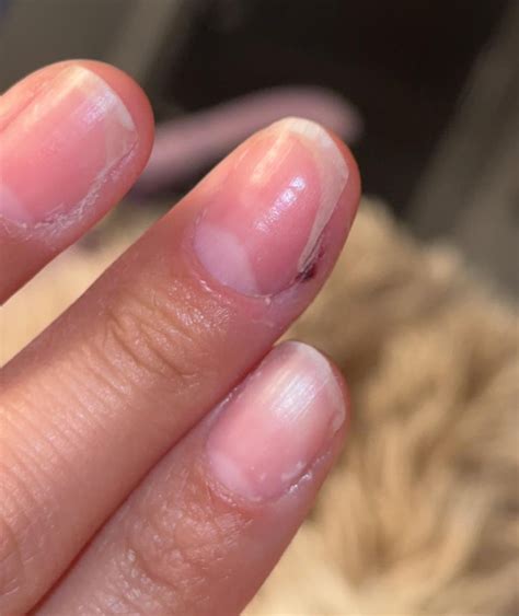 why is the white part of my fingernail growing like that? : r/calmhands