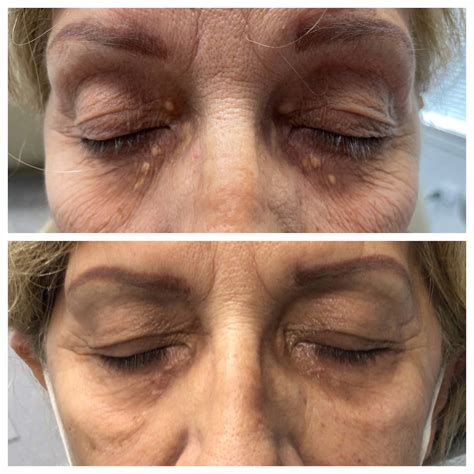Xantelasma Xanthelasma Removal London Dermasurge Clinic