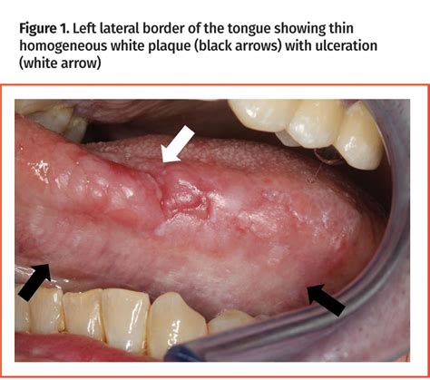 Leukoedema Dental