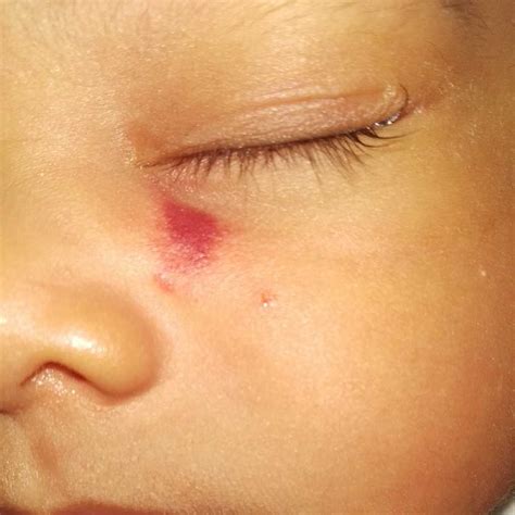 Red Spots On Baby Arms And Face at Jeniffer Rowe blog