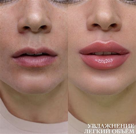 Before and after lip filler – Artofit