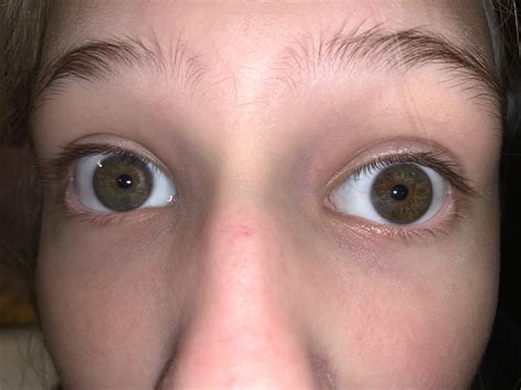 Complete Heterochromia