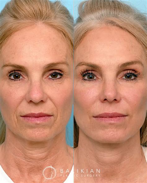 Facial Fat Transfer Before & After Patient Transformations