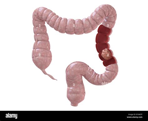 cancer du côlon Photo Stock - Alamy