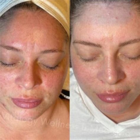 Microneedling Before and After 1 Treatment: Initial Transformation