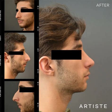 Rhinoplasty for Men: Goals & Benefits | Artiste Plastic Surgery