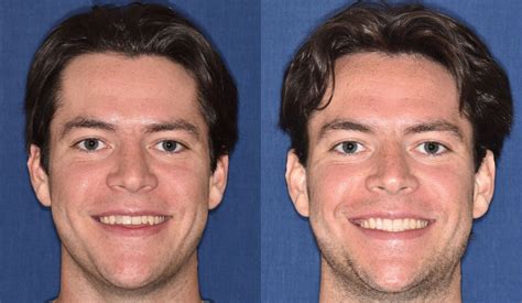 Before & Afters | Parks, Schmit & Fuller Orthodontics