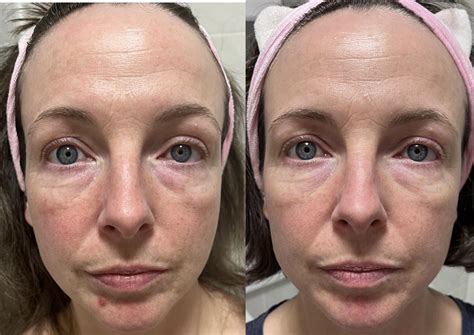 Azelaic Acid Before And After