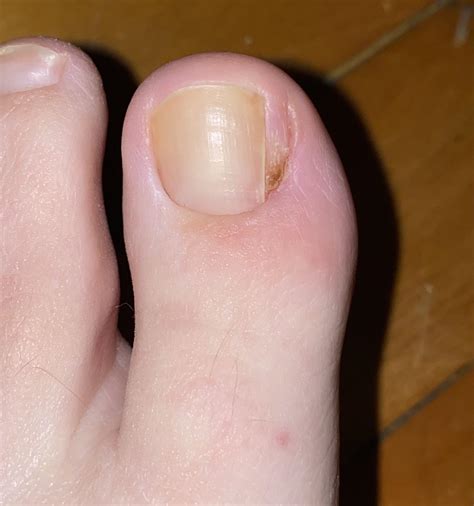 New pain almost 4 weeks after partial nail avulsion : r/Ingrown_Toenails