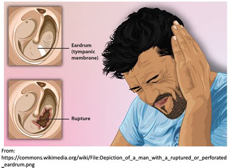 Perforated Ear Drum