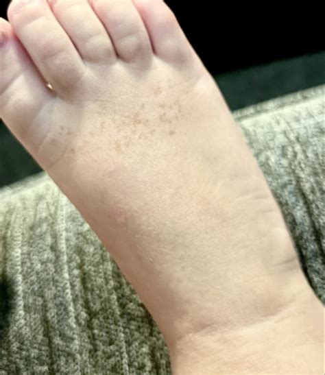 My 2 year old has a cluster of freckles across her right foot and has ...