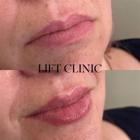 Lip fillers before and after - Lift Clinic Toronto