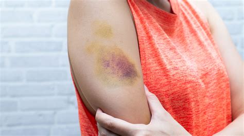 Why Do Bruises Sometimes Itch? - GoodRx
