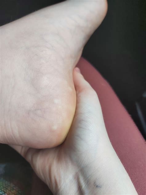 White Bumps On My Foot Near Big Toe Corns And Calluses NHS
