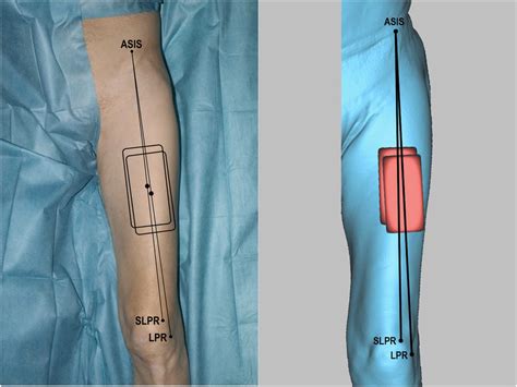 Evaluation of anterolateral thigh flap dimensions with virtual flap ...