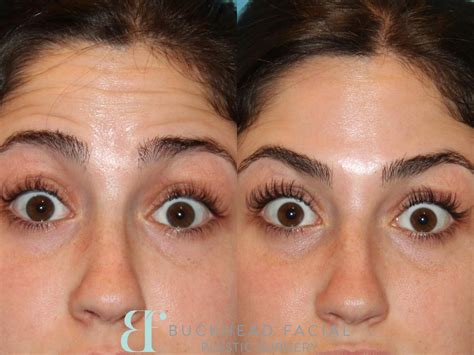 What Should I Look for in BOTOX® Before and After Photos? | Buckhead Facial Plastic Surgery