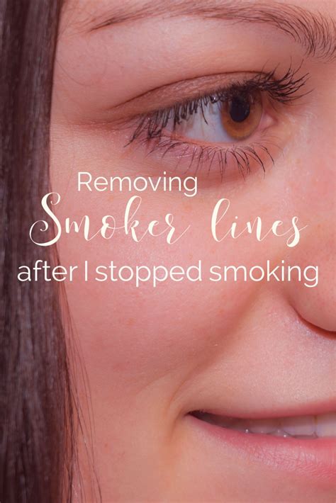 Removing Smokers Lines | The YR Peri-oral procedure combines Botox ...