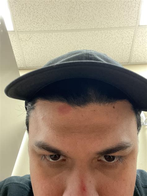 Sore inside nose wont heal! : r/Dermatology