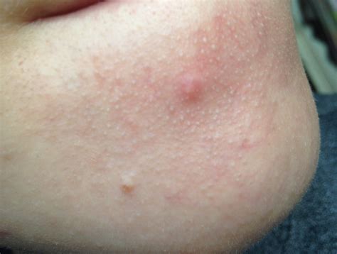Small bumps all over chin - what are they and how to get rid of them ...