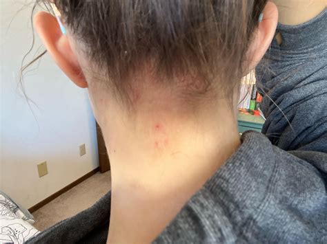 Itchy Rash On Back Of Neck At Hairline Treatment at Mario Wall blog