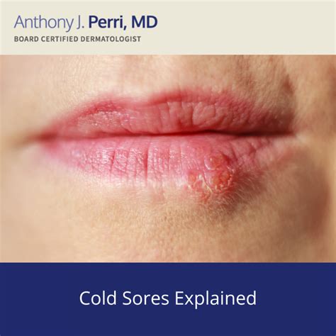 Actinic Keratosis - Cutaneous Horn | Perri Dermatology
