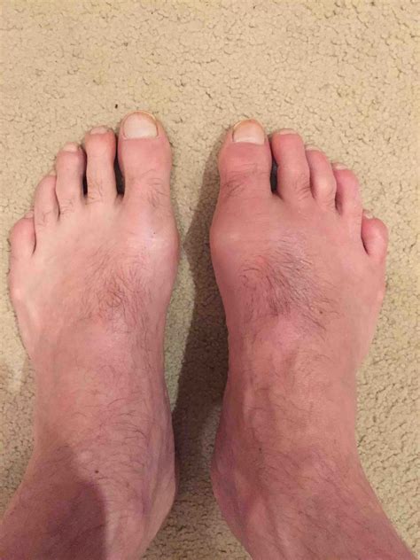 Gout Foot Skin Peeling at Peggy Rios blog