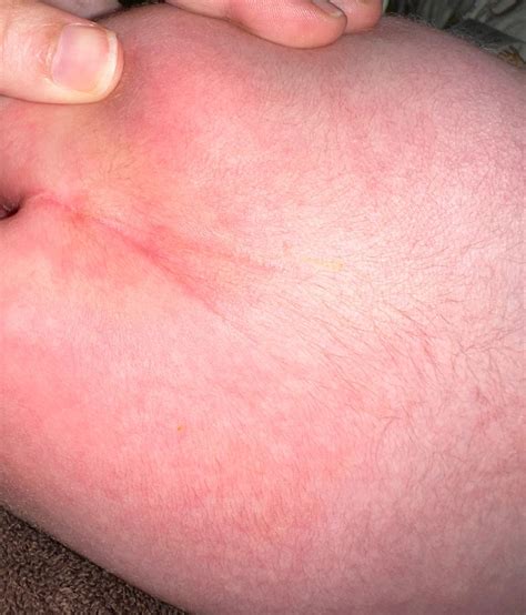 Sacral Dimple Pictures Infant