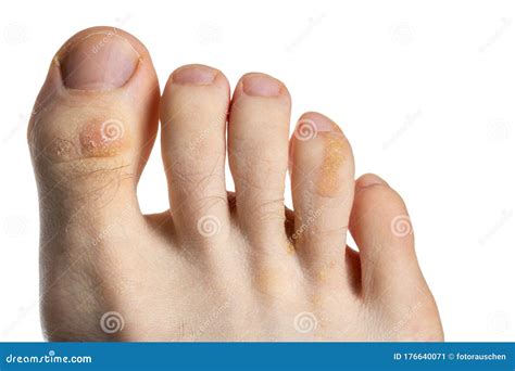 Corn Or Callus On Top Of Toe at Scott Mcrae blog