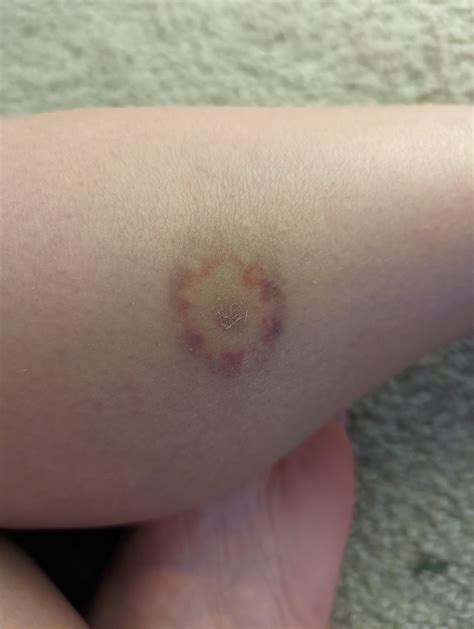 What is this, bruise or tick bite? : r/Lyme