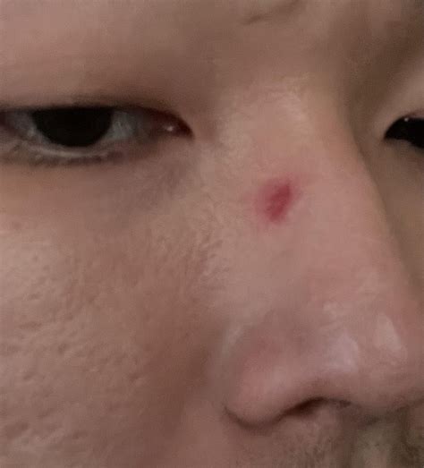 It’s been two weeks and this red dot on my nose is stay still. I wear ...