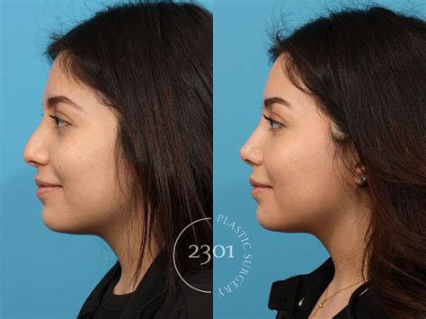 Understanding Rhinoplasty Swelling Stages: A Timeline & Tips For Recovery – 2301 Plastic Surgery