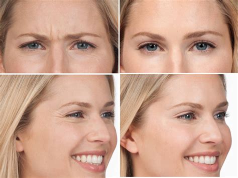 XEOMIN | AMA Clinic | Lynn MA