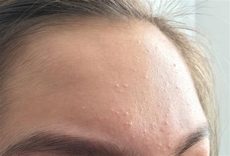 What Do Little Red Bumps On Face Mean
