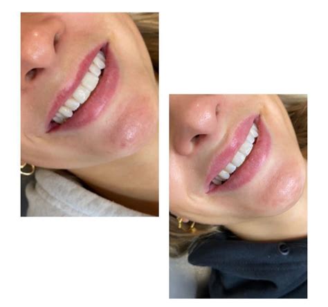 Lip-Flip Treatment - MicosmeticsUK - Essex Aesthetics