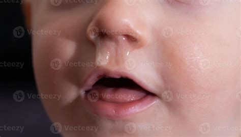 Yellow snot from a child s nose, close-up. Sinus infections, colds and ...