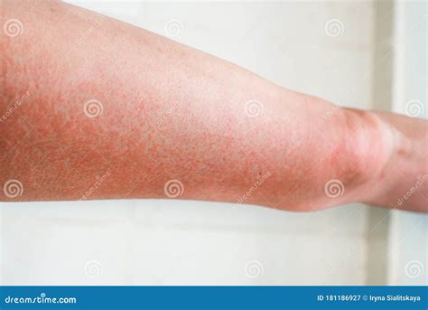 Severe Sunburn, Summer Tan, Poor Sun Protection. Sun Allergies, Obstruction, Itching Pain and ...