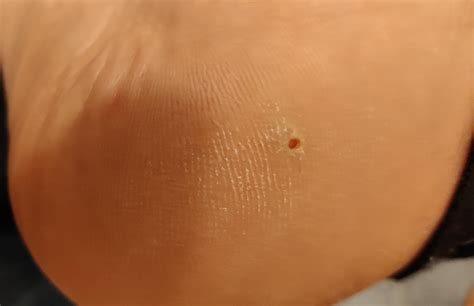 Why Do I Have Holes In My Feet at Donald Schenk blog