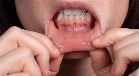 Unmasking the Culprits of Canker Sore and Finding Comfort