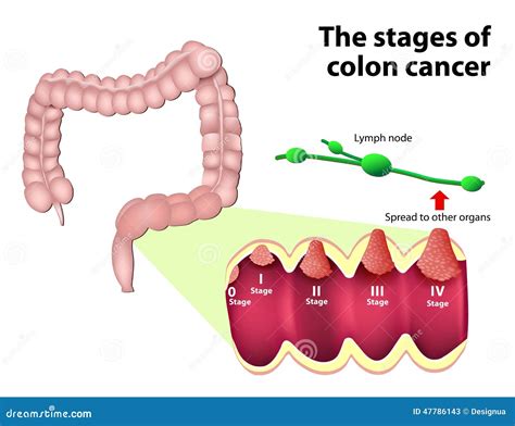 The Stages of Colorectal Cancer Stock Vector - Illustration of cross, digestive: 47786143